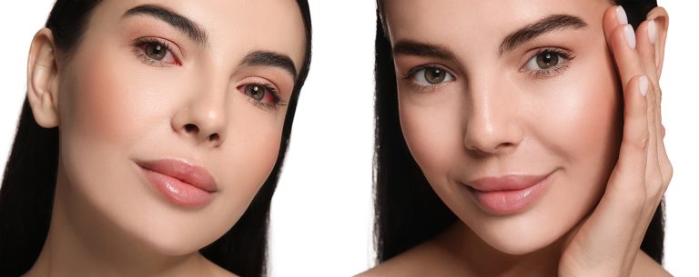 Before and after conjunctivitis treatment. Photos of woman with red and healthy eyes, collage